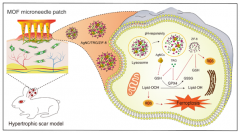 pH响应的金属-有机框架微针贴片，用于铁死亡介