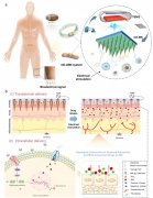 可穿戴自供电载药电子微针系统，用于炎症性皮