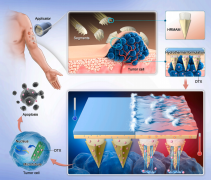 实现高效肿瘤局部给药的智能水热反应微针设计