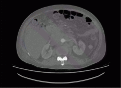 通用AI大模型Segment Anything在医学影像分割的性能