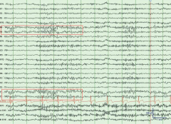 Normal Variants 正常变异脑电波形时域分析