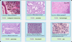 AI基础模型提升癌症诊断精确度,实现个性化治疗