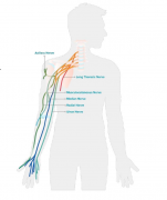 功能性电刺激（FES）—神经假肢