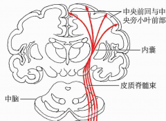功能性电刺激FES对中风后上肢功能的改善