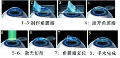 近视激光手术：准分子、飞秒、全飞秒的区别解