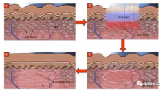 射频美容的原理是什么呢