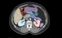基于医学影像分割大模型的飞标医学影像标注平