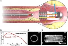 血管内超声（IVUS）成像系统在心血管疾病评估中